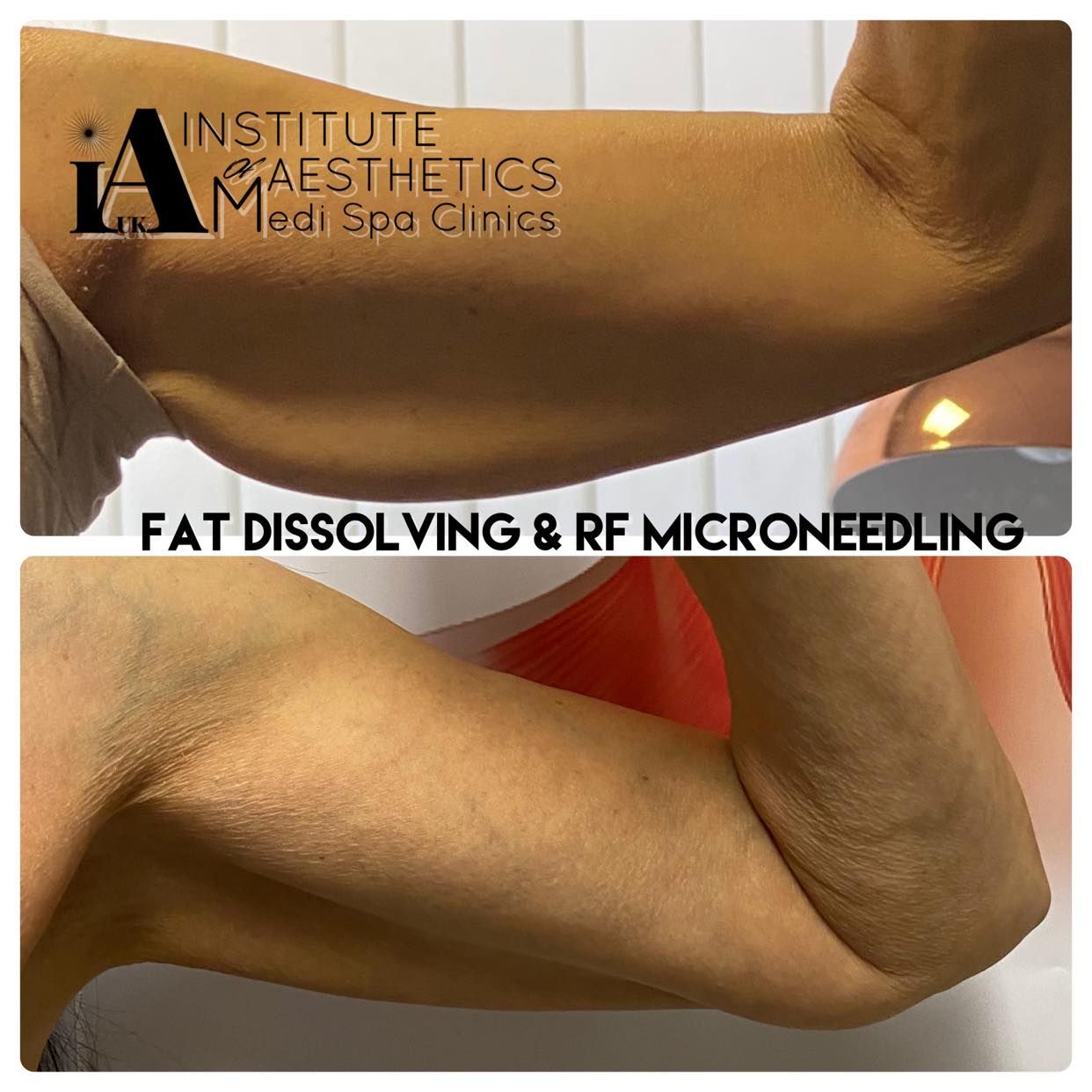 RF Microneedling & Fat Dissolving